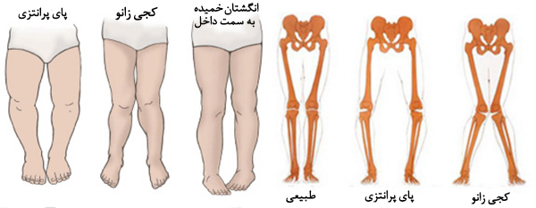 آموزش تصویری حرکات اصلاحی زانوی پرانتزی